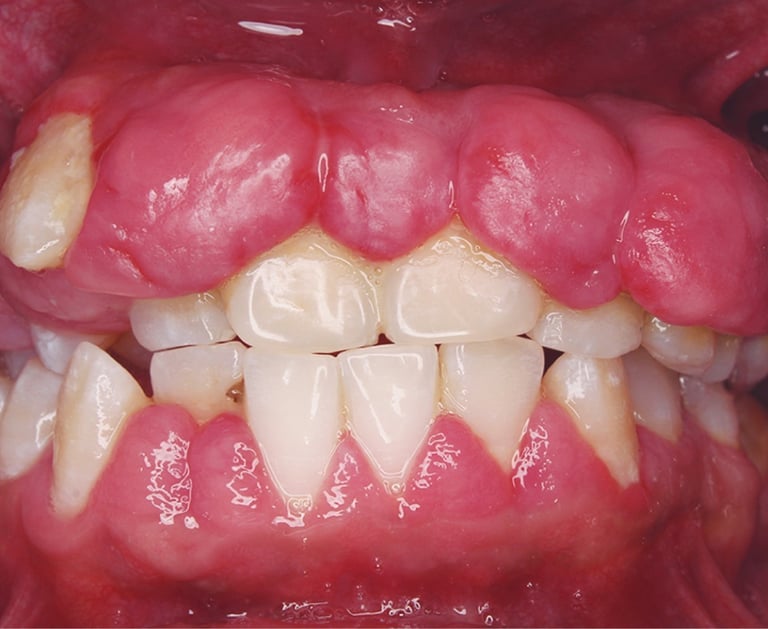 Treatment for bleeding gums