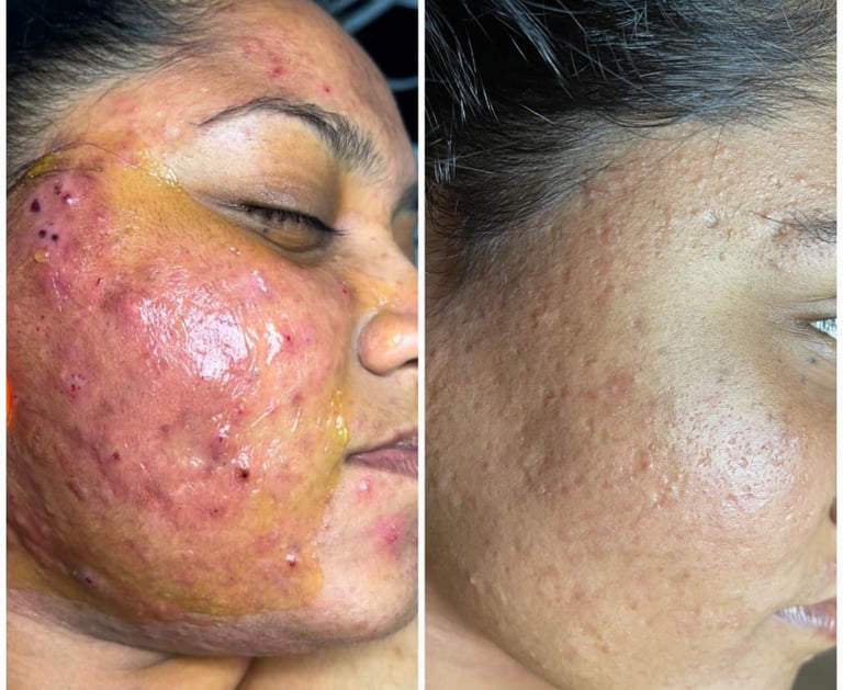 Clearer skin before and after acne treatment in Kandy clinic