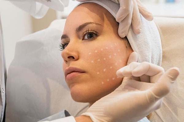 Mesoterapia Facial