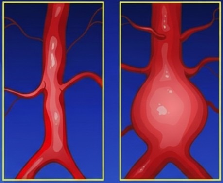 aneurisma aorta