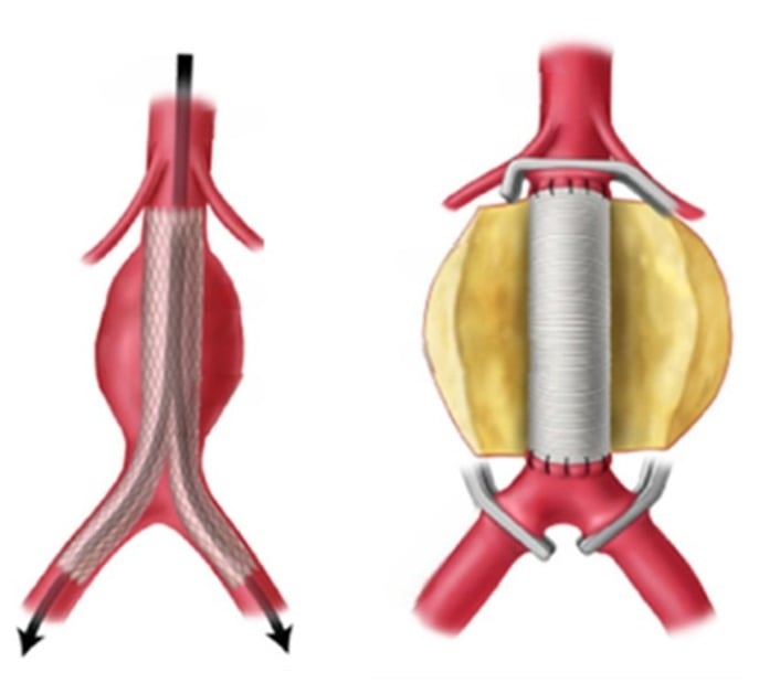 trattamento chirurgico e endovascolare aorta