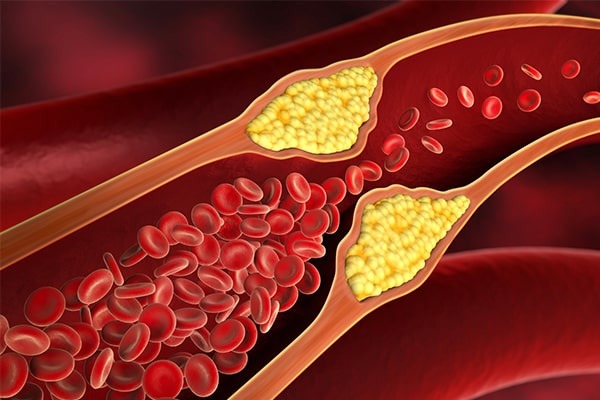 colesterolo, crampi ai polpacci
