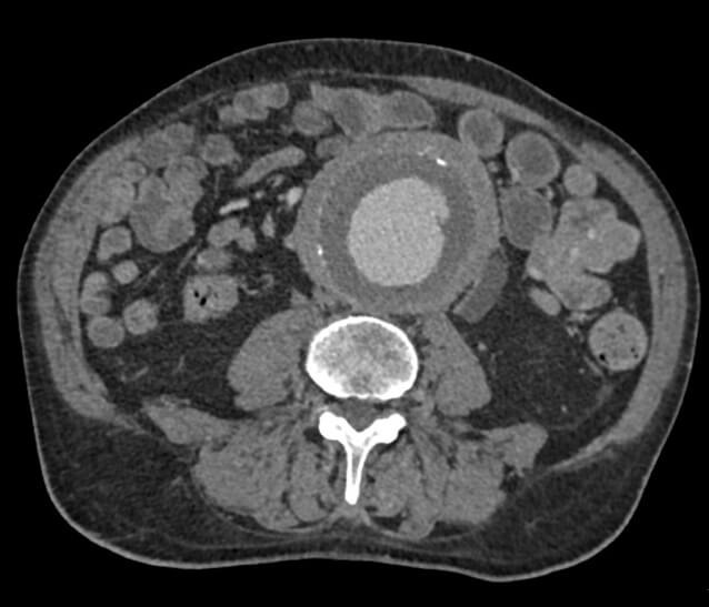 diagnosi doppler aorta e vasi addominali