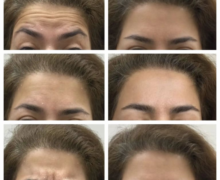 Dysport injection at Ariana Esthetic in Edmonton