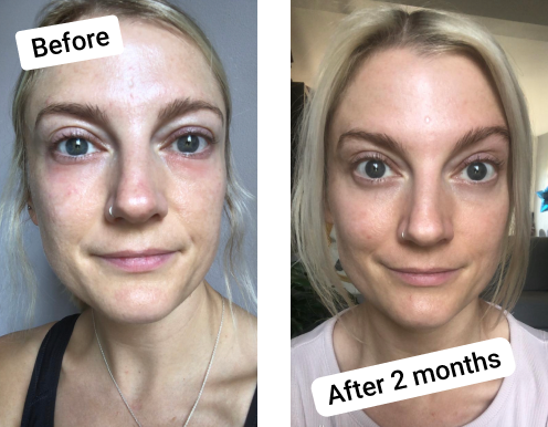 before and after collagen