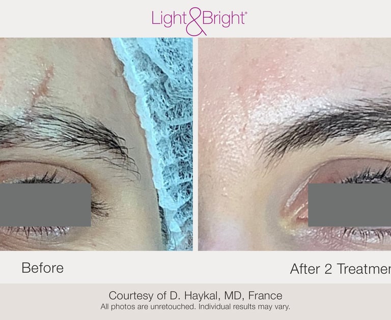 before and after scar and stretch mark treatment results in Hamilton clinic