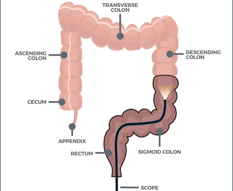 Colonoscopia demonstrando as partes anatômicas do intestino durante o exame.