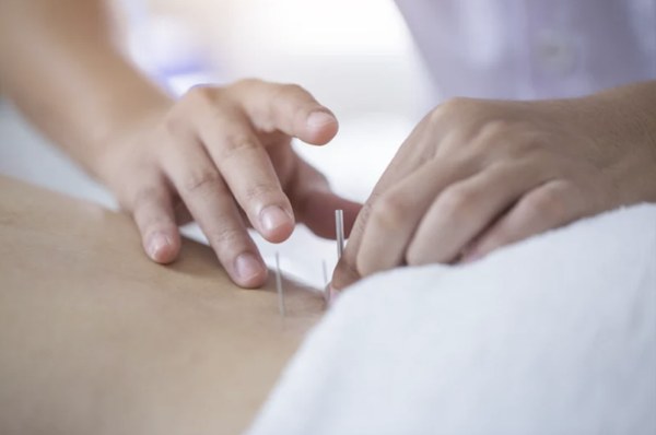 Professional practitioner performing acupuncture treatment with thin needles for holistic back pain relief.