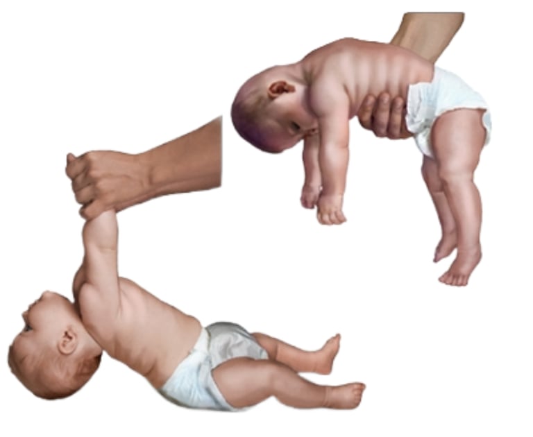 Niños con hipotonía