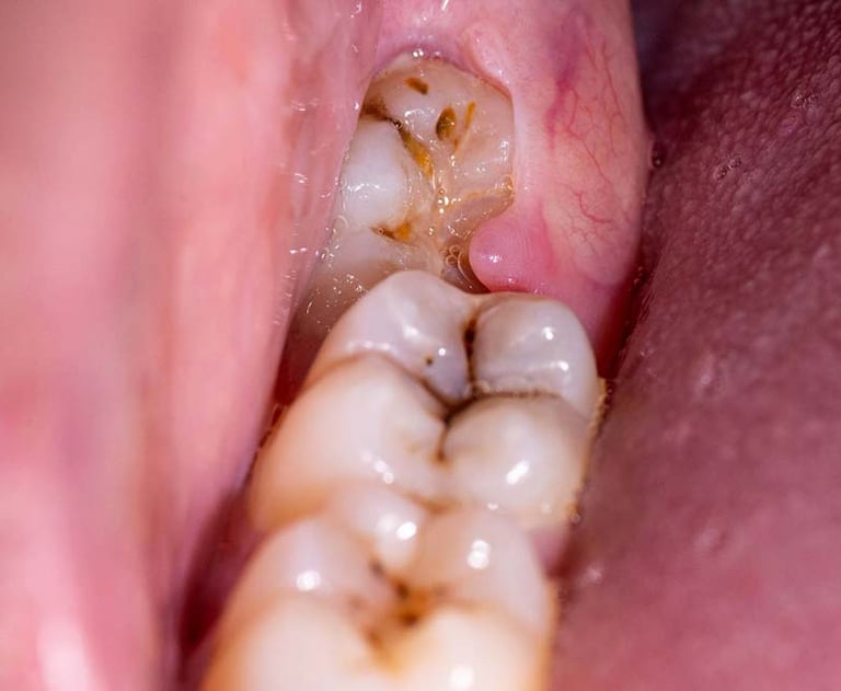 a image showing impacted wisdom third molar