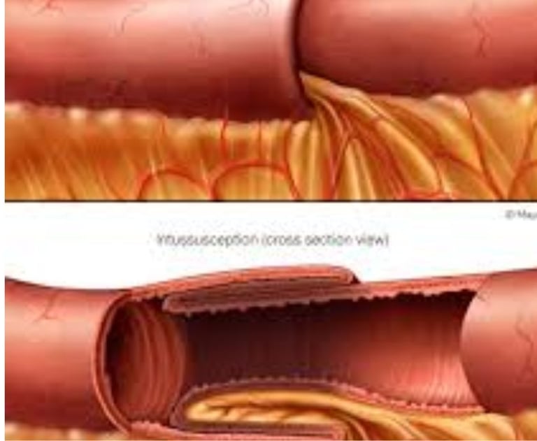 Emesis and Upper Digestive Tract Blockages
