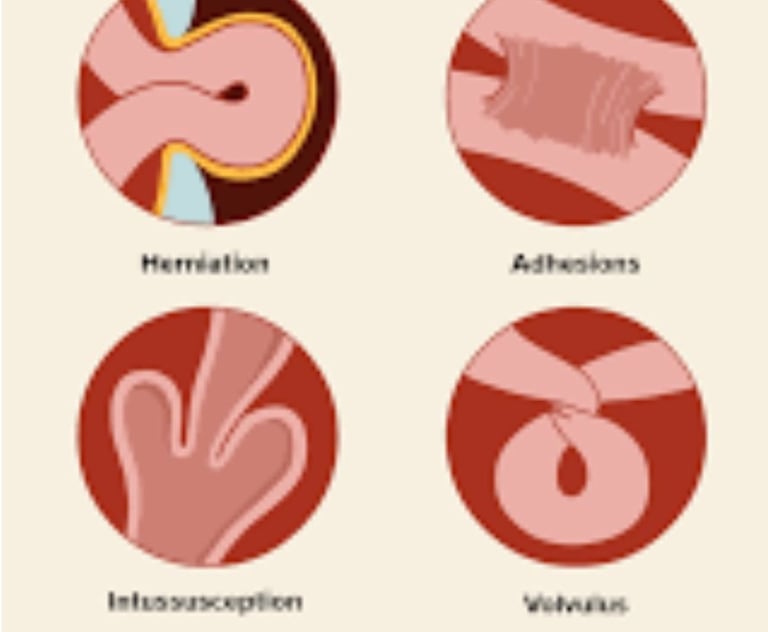 Emesis and Upper Digestive Tract Blockages
