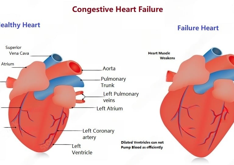 Congestive Heart Failure