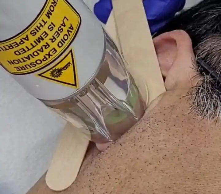 Ear hair removal laser at Ariana Esthetic Edmonton