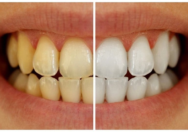 Teeth Cleaning and whitening at dentosculpt