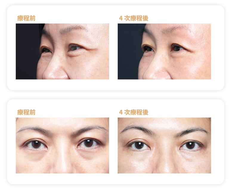 BTL眼部成效見證