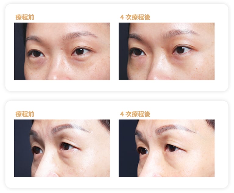 BTL眼部成效見證