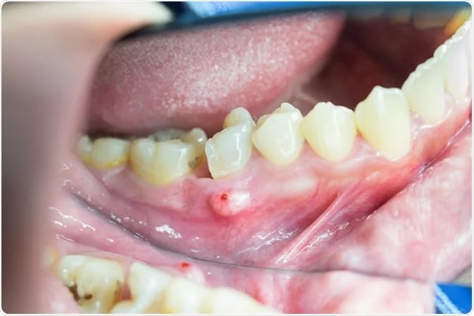 a image showing swelling around one broken molar tooth 