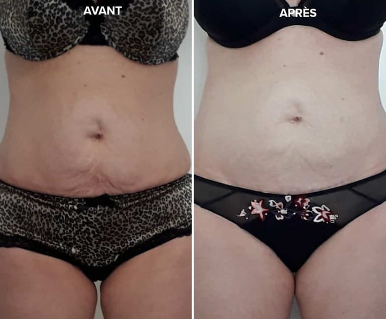 Photo Avant Après radiofréquence ventre