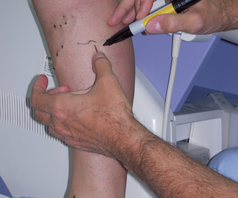 vascular ultrasound venous skin marking varicose veins surgery pre operative mapping vein skin imaging treatment leg swelling