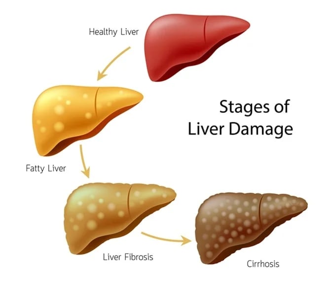 Cirrhosis of liver GASTRO FOUNDATION