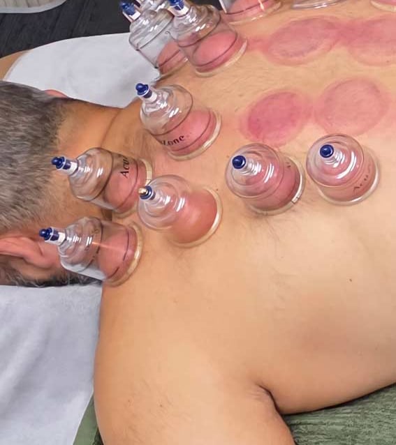 view from above of cupping being done on a male laying on a bed.