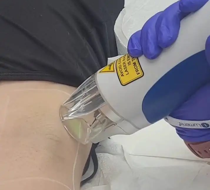 Underarms hair removal laser at Ariana Esthetic Edmonton