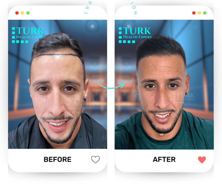 قبل وبعد زراعة الشعر
