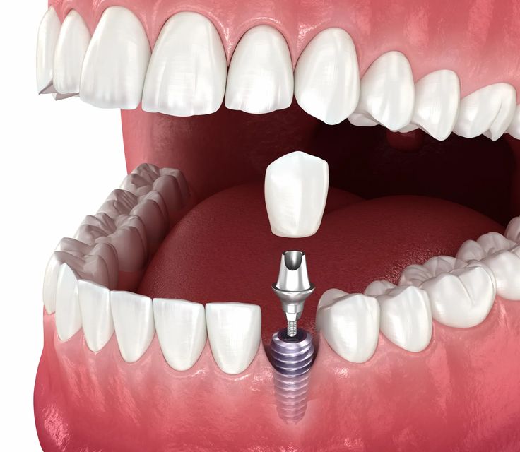 Diagram of a dental implant procedure showing the titanium screw, abutment, and porcelain crown.