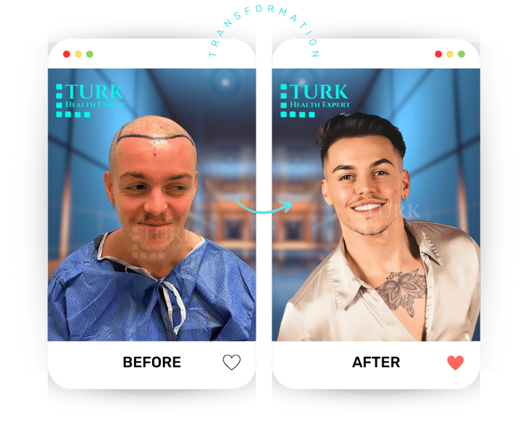 مشاهير زراعة الشعر