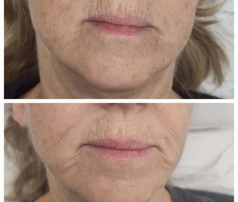 Before and after ResurFX treatment at Ariana Esthetic Edmonton