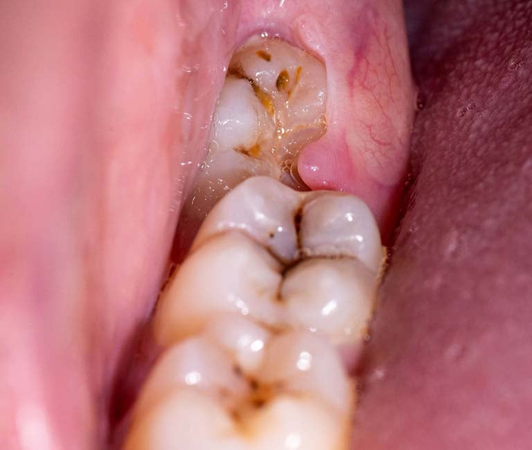 a image showing impacted wisdom tooth covered by swollen gums