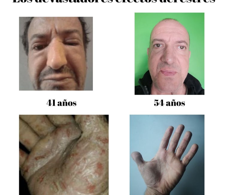 Los efectos del estrés