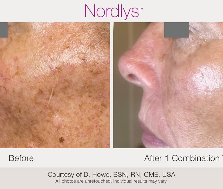 professional skin assessment for acne pigmentation and redness concerns in Hamilton Ontario