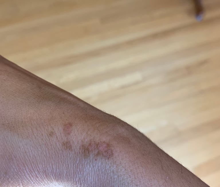 a person's wrist showing faded spots of light brown, with pink at the center, 2 weeks of healing from an inflamed response