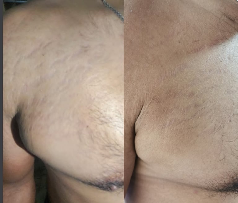 Résultat de camouflage et restructuration des vergetures masculines.