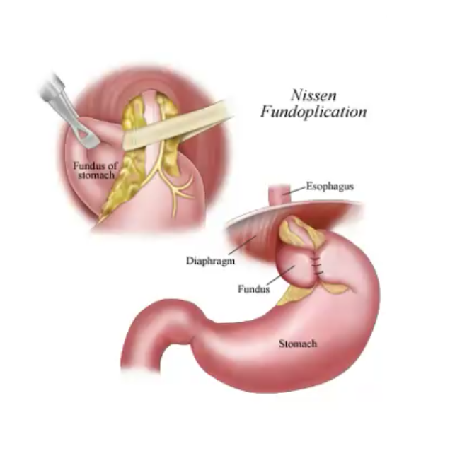 nissen fundoplicatio