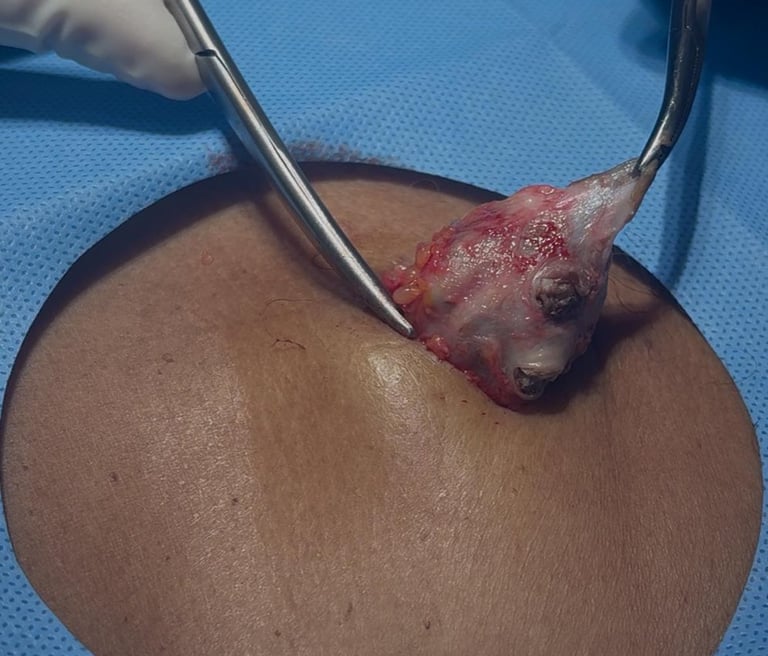 cisto epidérmico ou sebáceo