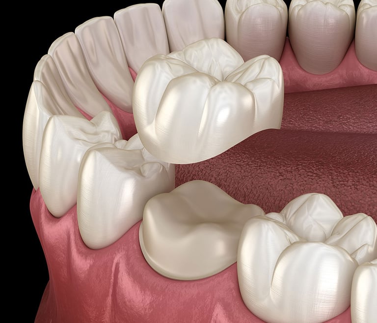 Corona dentale