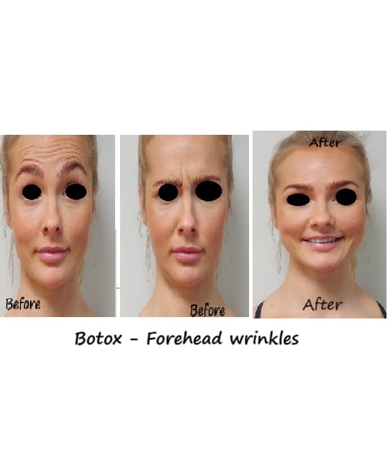 Botox in forehead and glabella before and after photo – reduced wrinkles and youthful appearance.