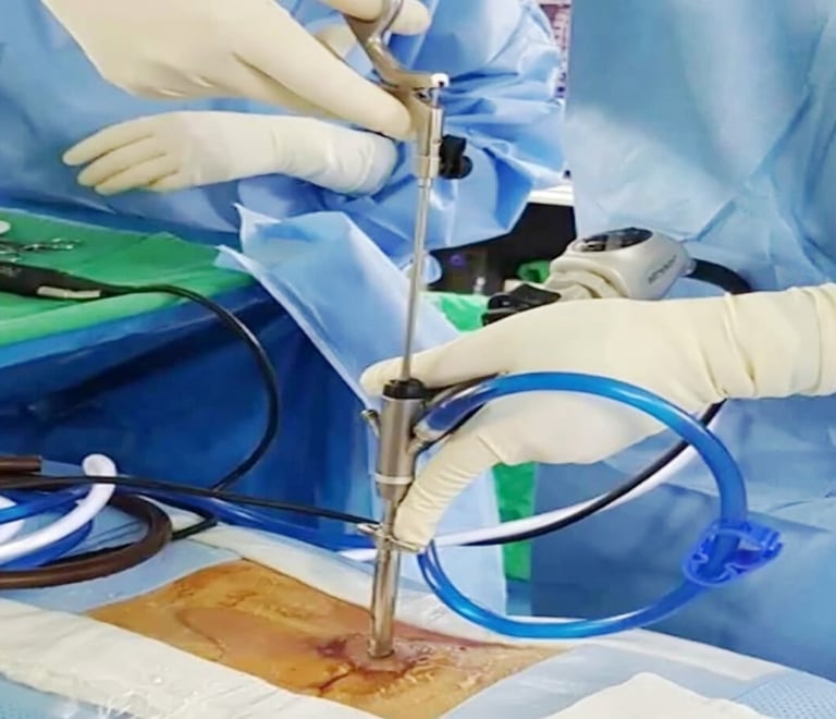 Figura mostrando cirurgia endoscópica da coluna monopertal em Fortaleza