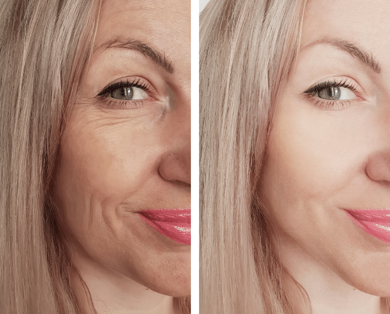 woman's face before and after skin tightening treatment
