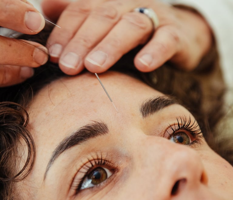 aculifting