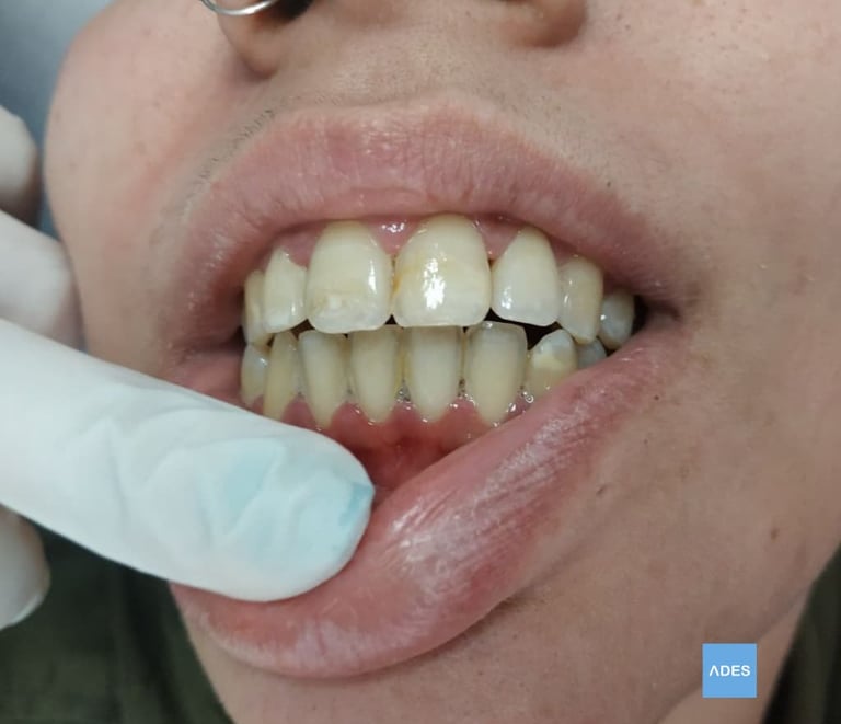 gingivitis