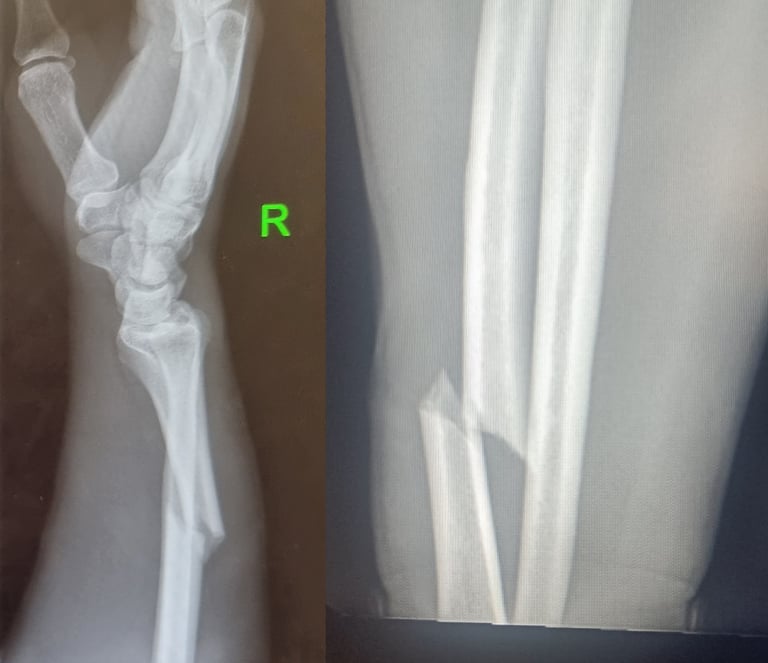 Mike MTB INJURY Broken Arm Twisted Oaks 04-05-2024