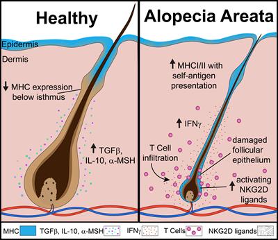 Alopecia Areata