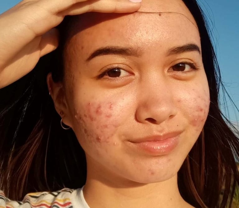 A woman receiving acne treatment in Vadodara, seeking acne scar treatment near her, in Vadodara