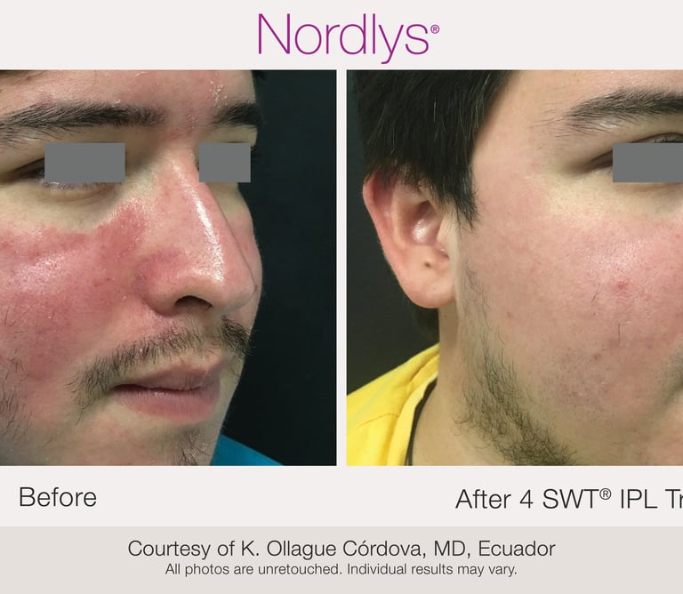 improved skin clarity after rosacea and redness treatment in Hamilton clinic