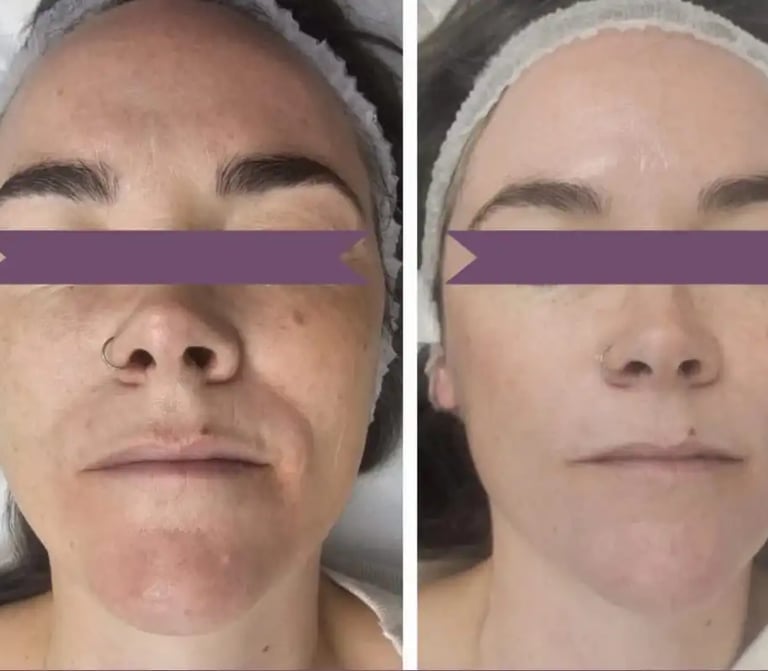 Peeling at Ariana Esthetic Edmonton