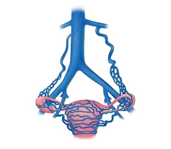 vascular ultrasound pelvic pain congestion syndrome vein venous chronic women reproductive ovarian ache vulval varice dull